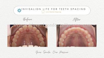 Invisalign