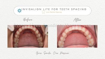 Invisalign