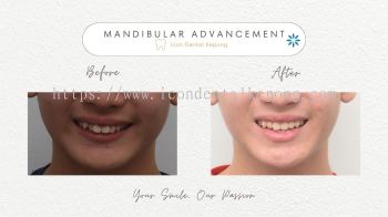 Invisalign