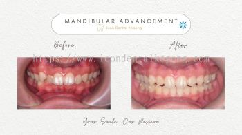 Invisalign