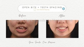 Invisalign