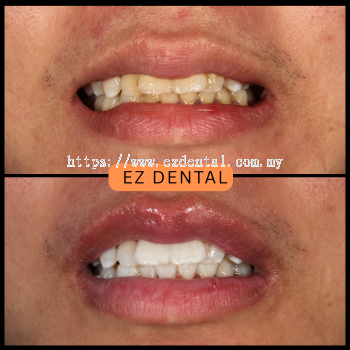 Teeth Whitening