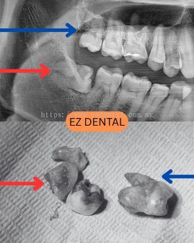 Wisdom Tooth Surgery