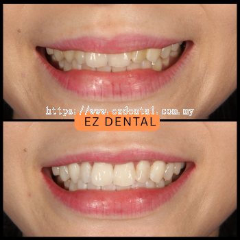 Teeth Whitening