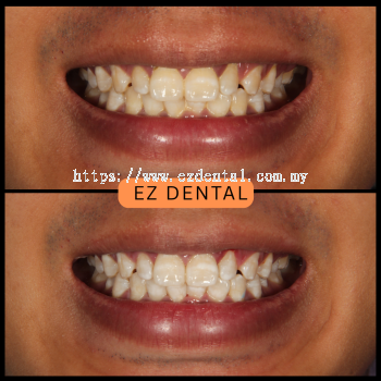 Teeth Whitening