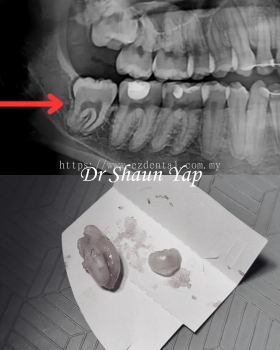 Wisdom Tooth Surgery