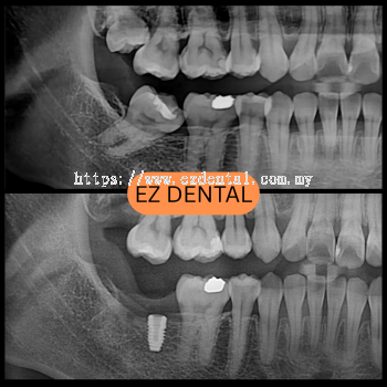 Dental Implant