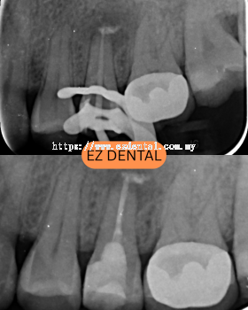 Root Canal Treatment