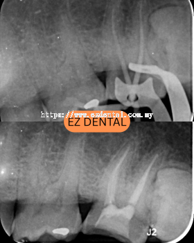 Root Canal Treatment
