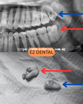 Wisdom Tooth Surgery