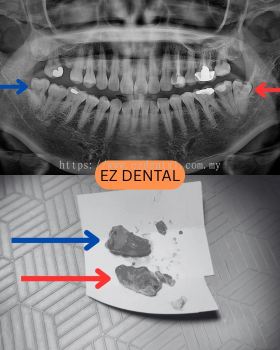 Wisdom Tooth Surgery