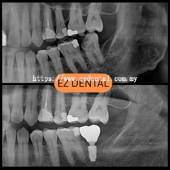 Dental Implant