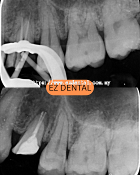 Root Canal Treatment