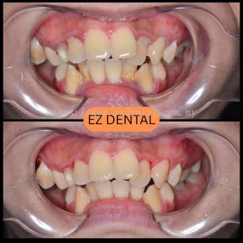 Scaling and Polishing
