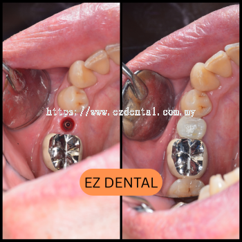 Dental Implant