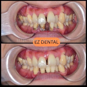 Scaling and Polishing