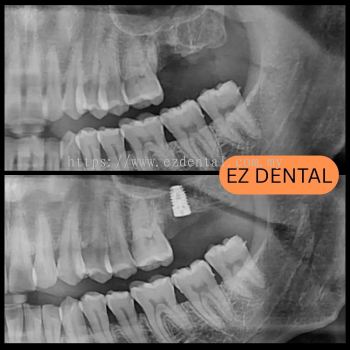 Dental Implant