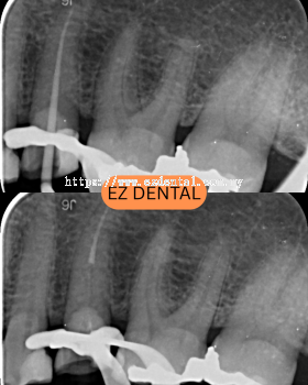 Root Canal Treatment