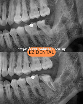 Root Canal Treatment