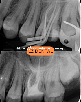 Root Canal Treatment