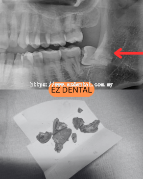 Wisdom Tooth Surgery