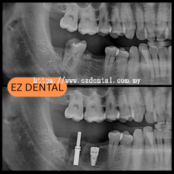 Dental Implant