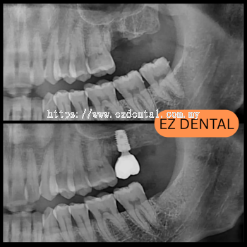 Dental Implant