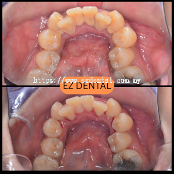 Scaling and Polishing