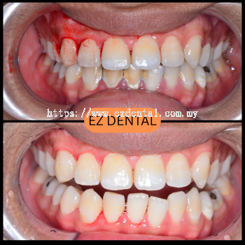 Scaling and Polishing
