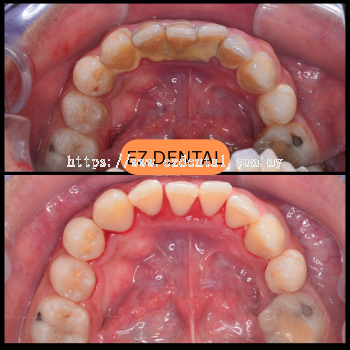 Scaling and Polishing