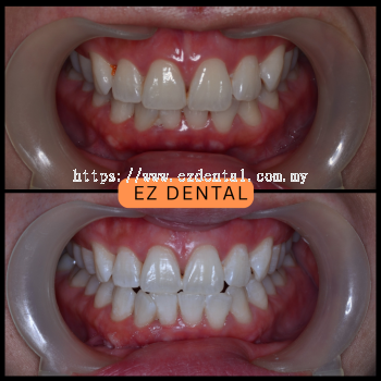 Teeth Whitening