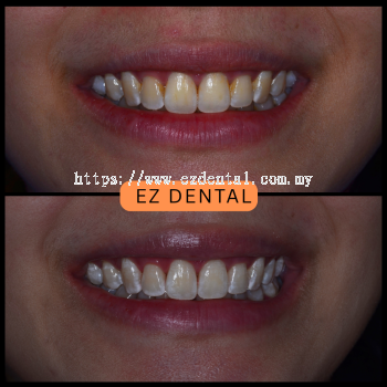 Teeth Whitening Before & After | EZ Dental Studio Seri Kembangan