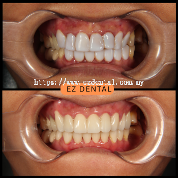 Veneers