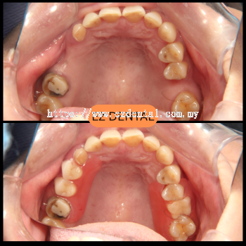 Denture Smile Transformation | Seri Kembangan