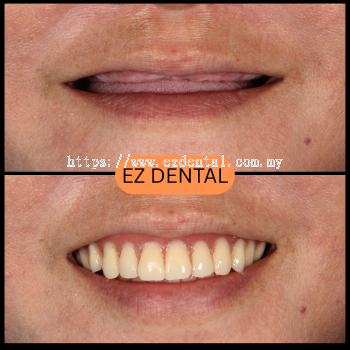 Denture Before & After | EZ Dental Studio Seri Kembangan