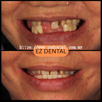Denture