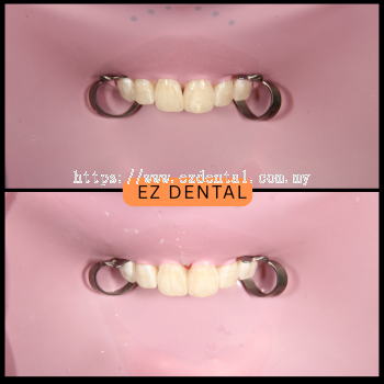 Composite Filling Results | EZ Dental Studio Seri Kembangan