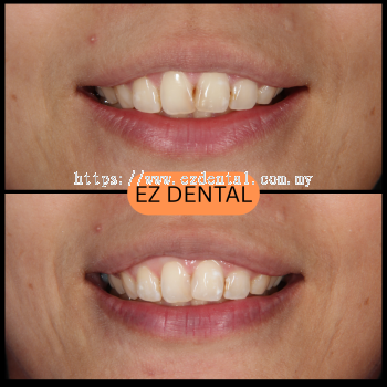 Composite Fillings Before & After | EZ Dental Studio Seri Kembangan