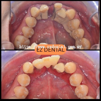 Scaling and Polishing
