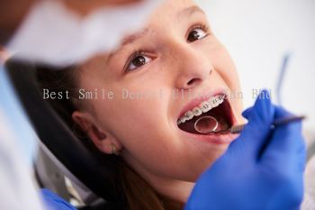 Braces (Traditional Braces)