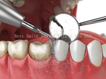Periodontal Maintenance