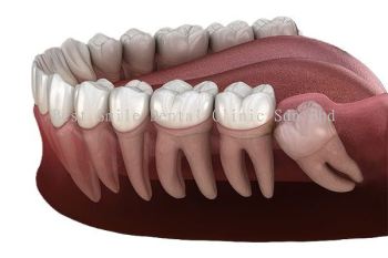 Wisdom Tooth Extraction