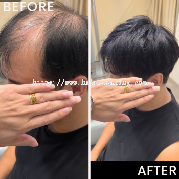 Invisible Hair System Before & After | Hair Replacement Malaysia | Hair Wigs King