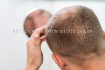 Male Pattern Hair Loss Treatment